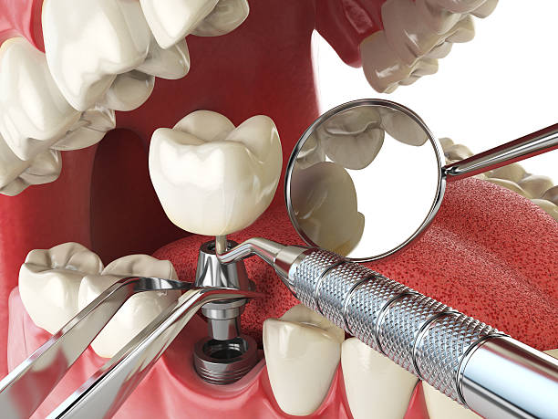 Best Emergency Tooth Extraction in Ama, LA